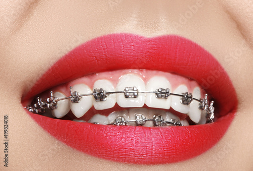 Beautiful macro shot of white teeth with braces. Dental care photo. Beauty woman smile with ortodontic accessories