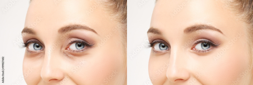 Lower and upper  Blepharoplasty.