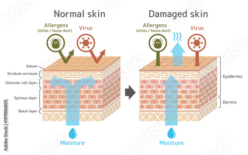 Sectional view of the skin.Comparison illustration of protection effect between healthy skin and wounded skin. With text. 