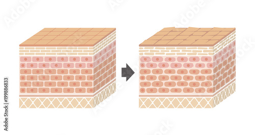 Sectional view of the skin.Comparison illustration of healthy skin and wounded skin. 