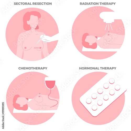 Breast Cancer Treatments set.  Sectoral resection, radiation, chemo, hormonal therapy.  Medicine, pathology, anatomy, physiology. Vector illustration. Healthcare poster or banner template.
