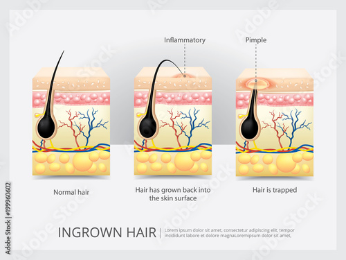 Ingrown Hair Structure Vector Illustration