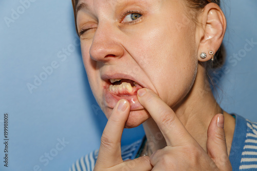 Canvas Print Women, showing mouth without tooth (broken) using fingers