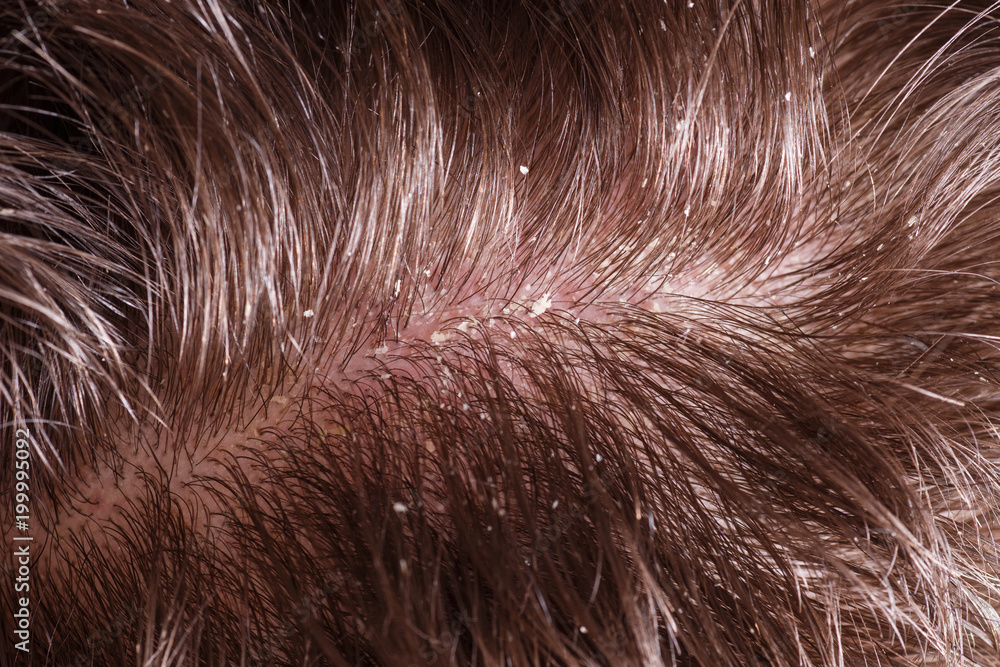 Fototapeta premium Dandruff on male dark hair