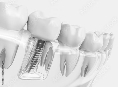 Fototapeta Naklejka Na Ścianę i Meble -  Tooth human implant 