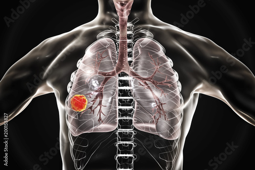 Lung cancer, medical concept, 3D illustration showing cancerous tumor inside human lung