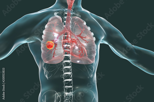 Lung cancer, medical concept, 3D illustration showing cancerous tumor inside human lung
