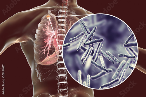 Secondary tuberculosis in lungs and close-up view of Mycobacterium tuberculosis bacteria, 3D illustration
