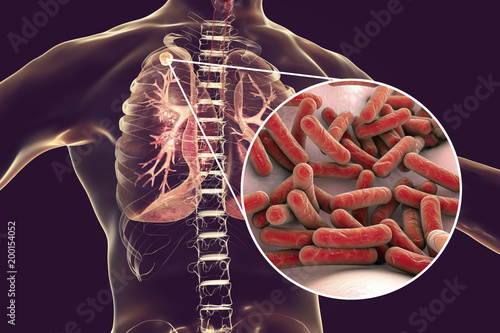 Secondary tuberculosis in lungs and close-up view of Mycobacterium tuberculosis bacteria, 3D illustration photo