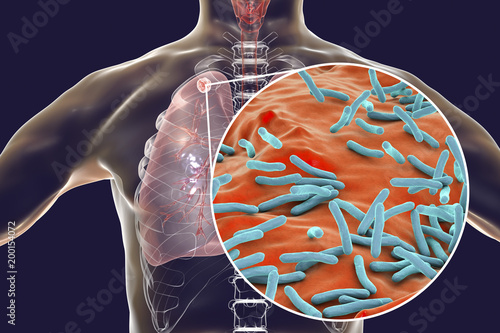 Secondary tuberculosis in lungs and close-up view of Mycobacterium tuberculosis bacteria, 3D illustration