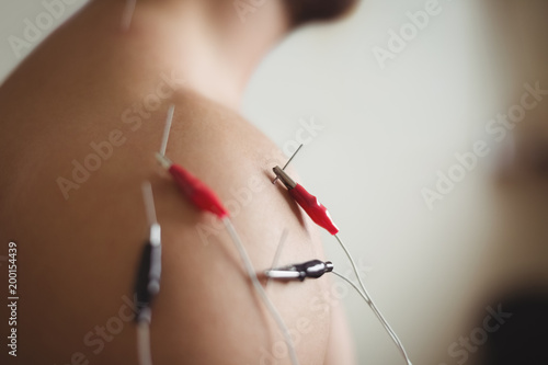 Close-up of patient getting electro dry needling photo