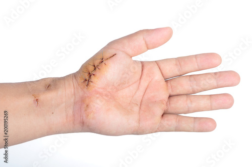 suture wound on hand isolate on white photo
