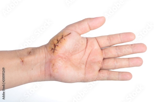 suture wound on hand isolate on white