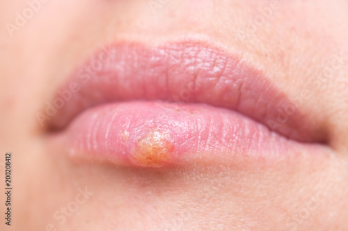 Herpes on lips photo