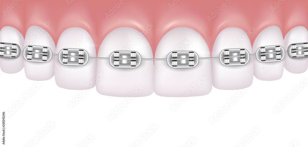 Perfect White Teeth With Braces