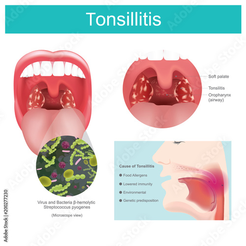 Tonsillitis.  Inflammation of the soft tissue in the mouth and pain in swallowing occurs. Illustration.