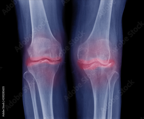 x-ray image of both knee Osteoarthritis (OA Knee), show narrow joint space ( joint cartilage loss ) , osteophyte , subchondral sclerosis, Radiography with deformed knee joint photo