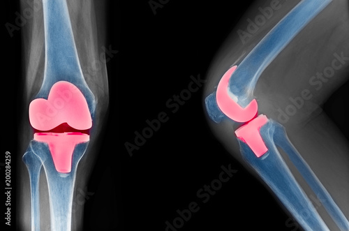 Fényképezés knee x-ray show total knee replacement