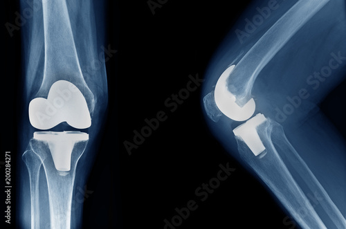 x-ray show knee joint replacement / knee arthroplasty front view and side view