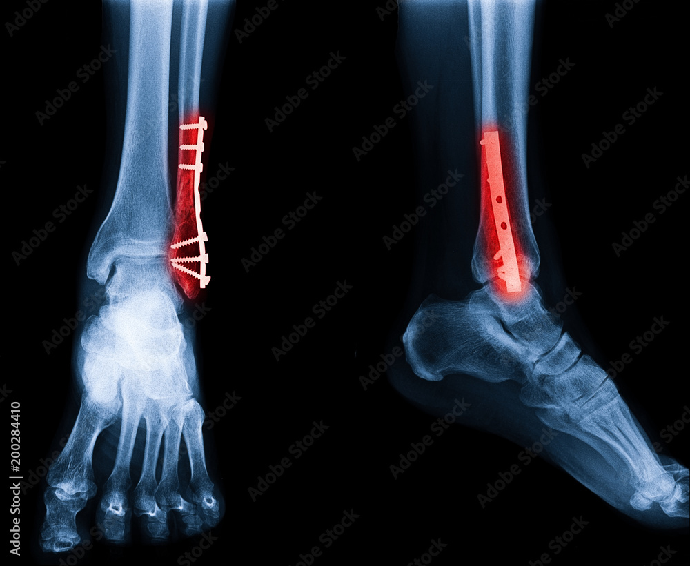 Xray image of ankle fracture , broken ankle , pott fracture fix by