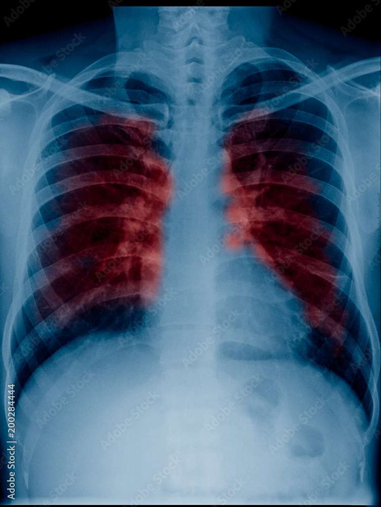 View of a adult x-ray film, taken to examine the lungs for a medical diagnosis red color show secretion or cancer in lungs View of a adult x-ray film, taken to examine the lungs for a medical diagnosis red color show secretion or cancer in lungs