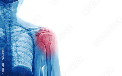 X Ray image of patient who have shoulder pain isolated on white background, space for your message and idea medical concept photo