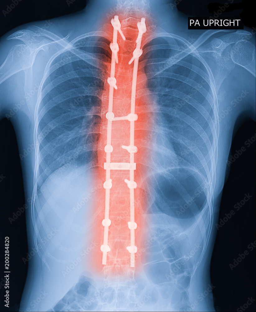 Xray image of adult patient spine show Scoliosis surgery fix by long