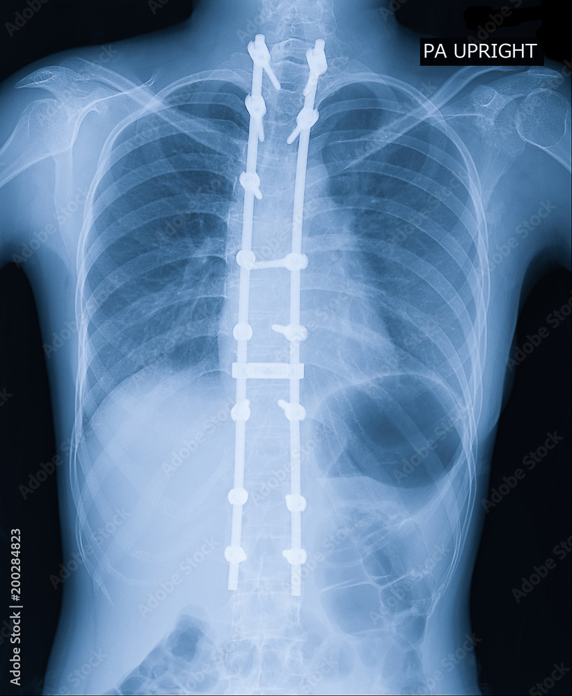 X-ray image of adult patient spine show Scoliosis surgery fix by long metal rod and many screw for spinal bend in adult people. Adult scoliosis fix Medical concept. X-ray image of adult patient spine show Scoliosis surgery fix by long metal rod and many screw for spinal bend in adult people. Adult scoliosis fix Medical concept.