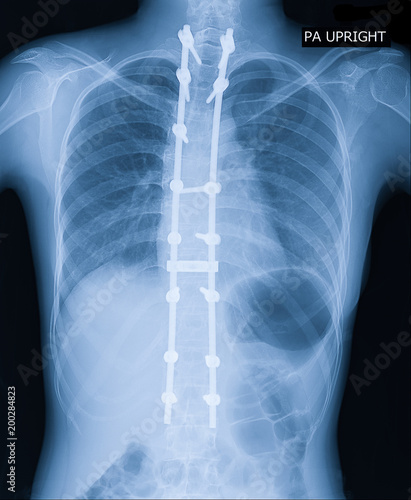 Photography X-ray image of adult patient spine show Scoliosis surgery fix by long metal rod and many screw for spinal bend in adult people
