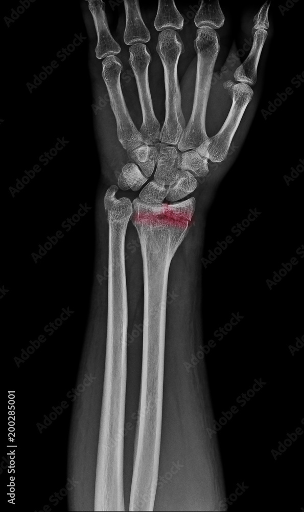 wrist x ray / x-ray show Distal Radius Fractures (Broken Wrist) mark with red color wrist x ray / x-ray show Distal Radius Fractures (Broken Wrist) mark with red color
