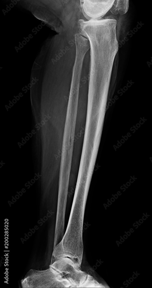 Lower leg xray , xray image of leg side / latteral view , xray of