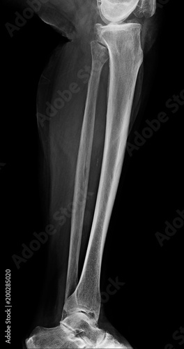 Fotografía Lower leg xray , x-ray image of leg side / latteral view , xray of normal leg bo