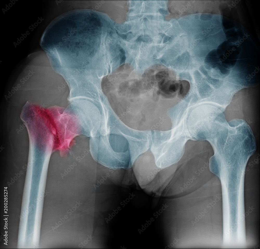 Hip fracture xray photo image. Xray of hip joint for elderly patient