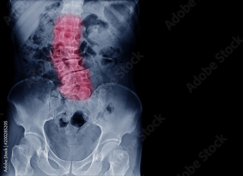 Fotografi X-ray image of elder patient spine show Scoliosis and spinal bend in old people