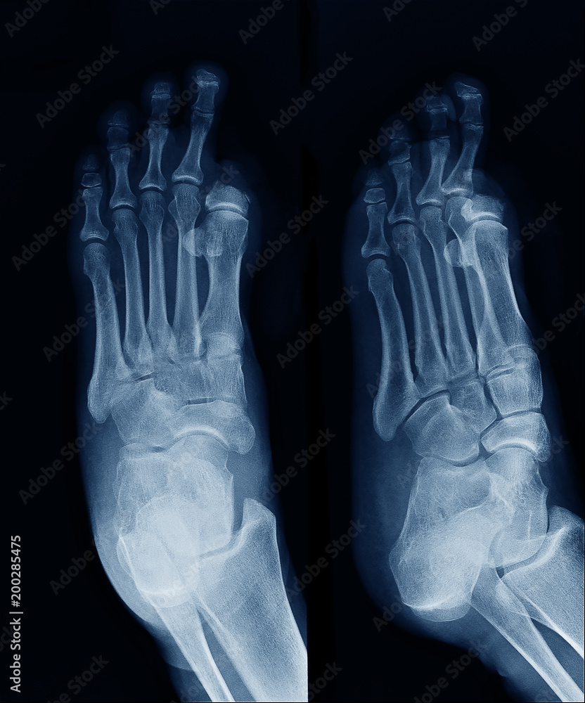X-ray image of foot , show Big toe amputated X-ray image of foot , show Big toe amputated