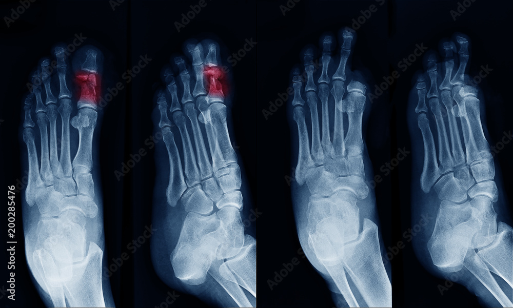 Xray image of foot , can see fracture at Big toe at red area mark and