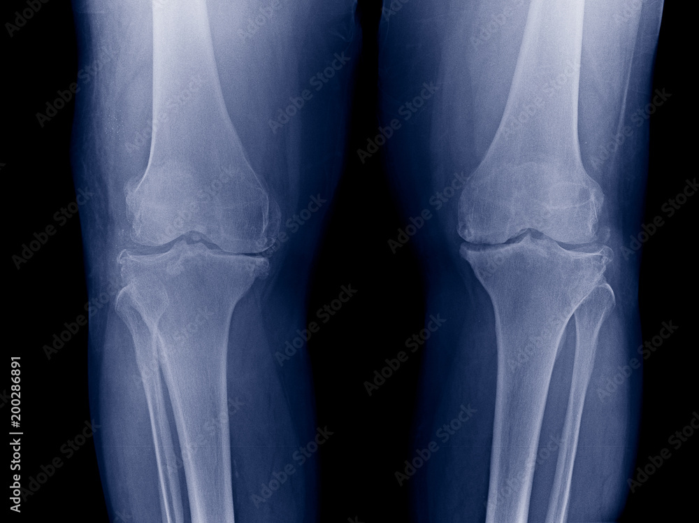 Osteoarthritis Knee ( OA Knee ). Film x-ray both knee ( front view ) show narrow joint space ( joint cartilage loss ) , osteophyte , subchondral sclerosis Osteoarthritis Knee ( OA Knee ). Film x-ray both knee ( front view ) show narrow joint space ( joint cartilage loss ) , osteophyte , subchondral sclerosis