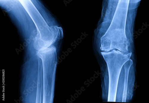 Osteoarthritis (OA) knee . film x-ray AP ( anterior - posterior ) and lateral view of knee show narrow joint space, osteophyte ( spur ), subchondral sclerosis, knee joint inflammation photo