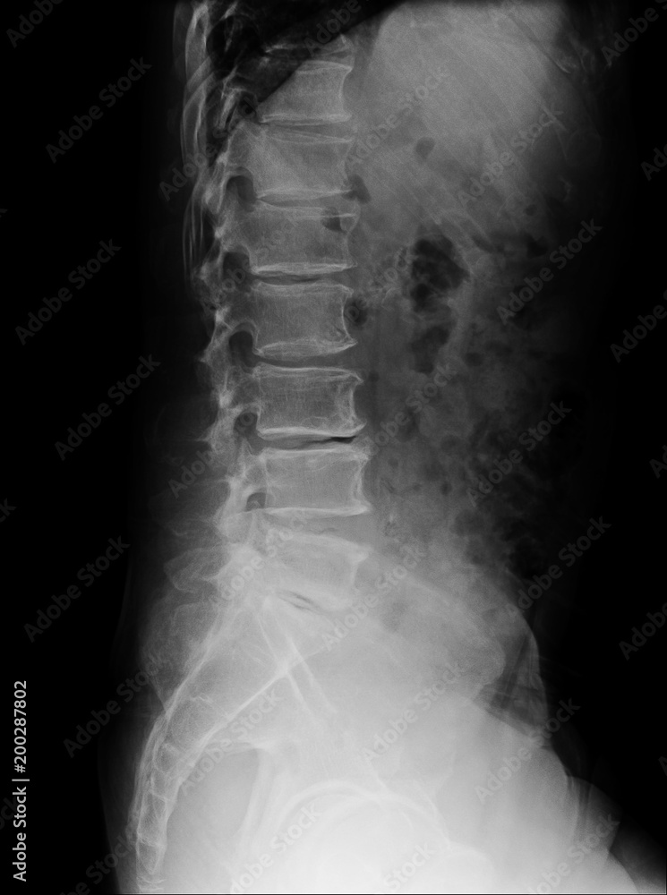 lumbar spine of a human body on xray side view. Stock Photo Adobe Stock