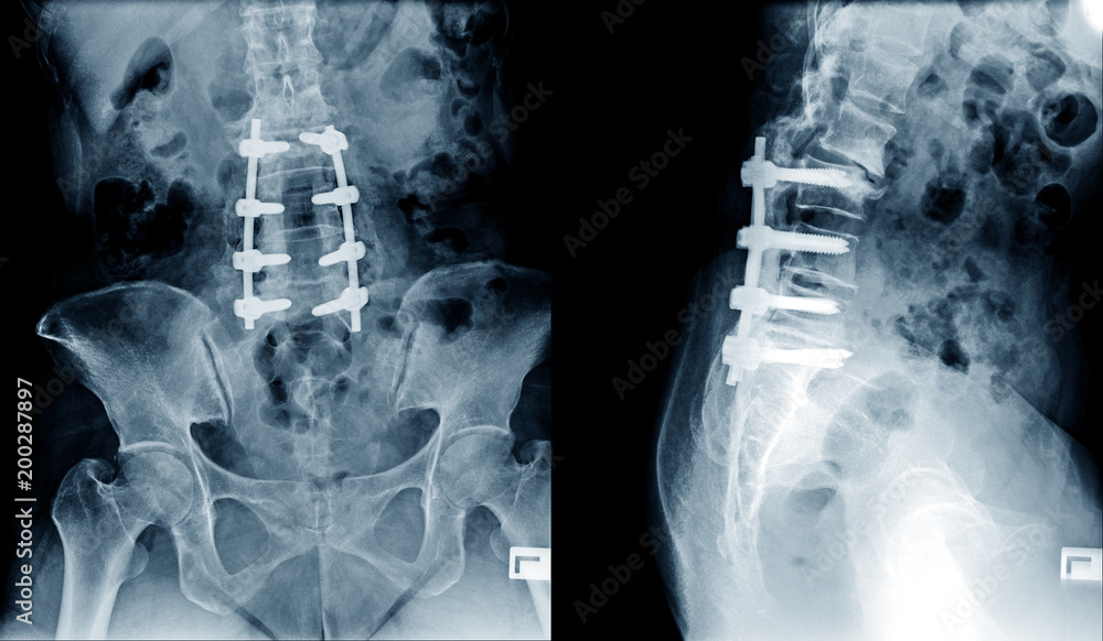 x-ray-image-of-lumbar-spine-postoperative-treatment-for-degenerative