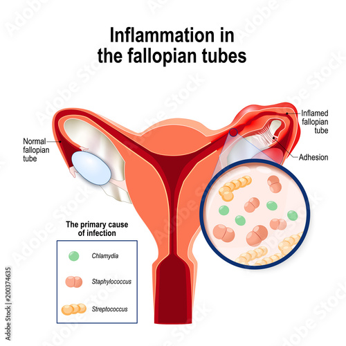 Inflammation in the fallopian tubes and primary cause of infection