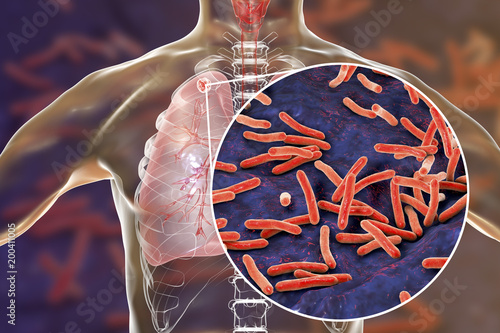 Secondary tuberculosis in lungs and close-up view of Mycobacterium tuberculosis bacteria, 3D illustration photo