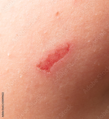 A wound on the human skin as a background
