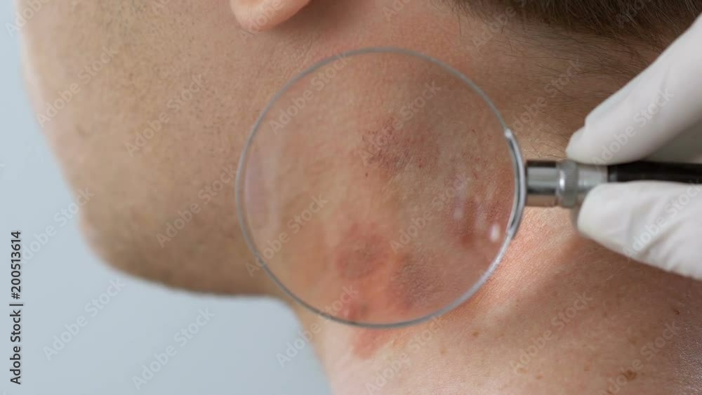 Dermatologist examining neck rashes with magnifying glass, allergy
