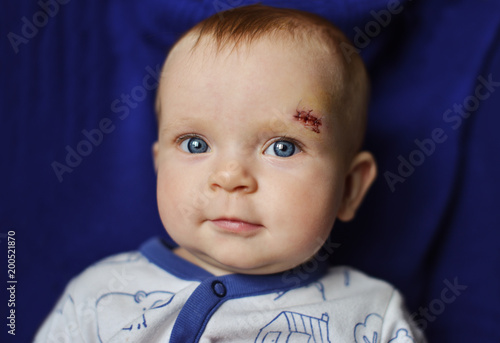 baby with scar on the face