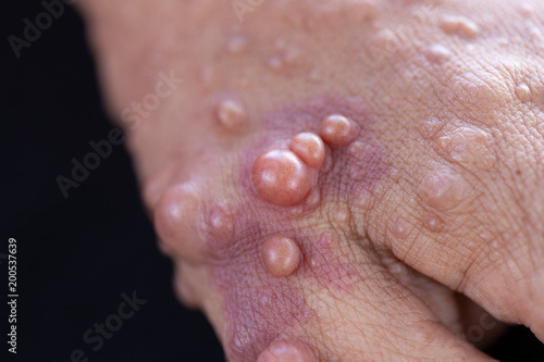 Neurofibromatosis (NF) is conditions in which tumors grow, symptoms include light brown spots on the skin. photo