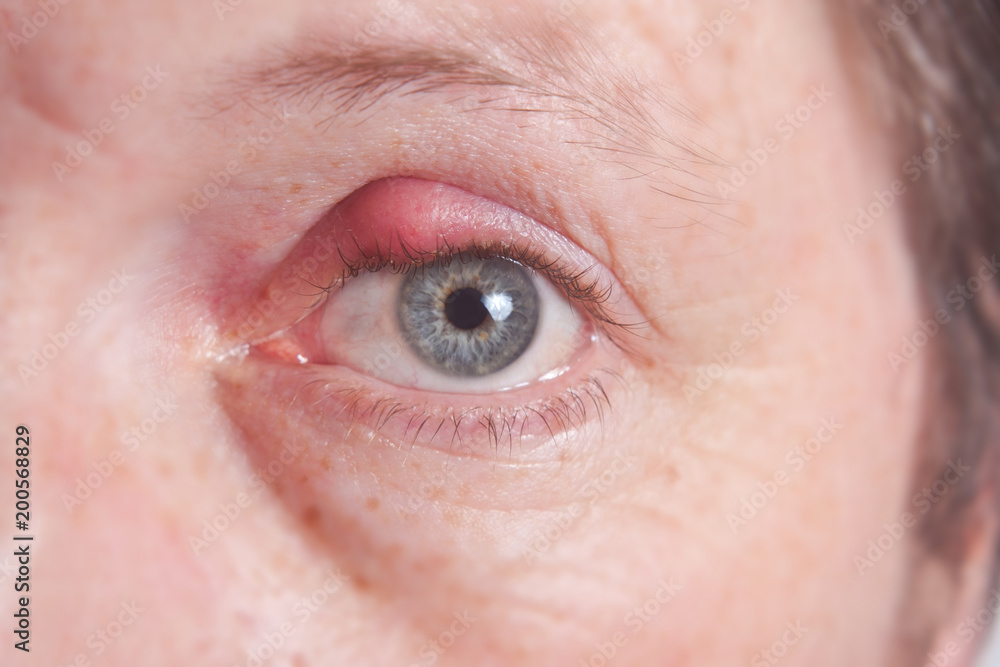 Fototapeta premium Painfully red eye sty, infected purulent eye