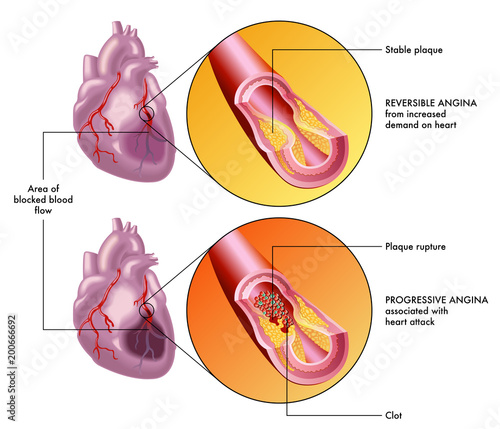 medical vector illustration of the human heart and the effects of a reversible and a progressive angina