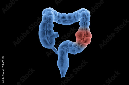 3D x-ray human large intestine cancer. Part of anatomy human body model with organ system.