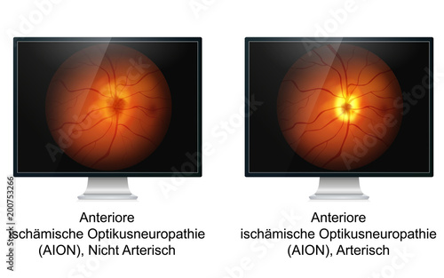 Anteriore ischämische Optikusneuropathie Unterschied
